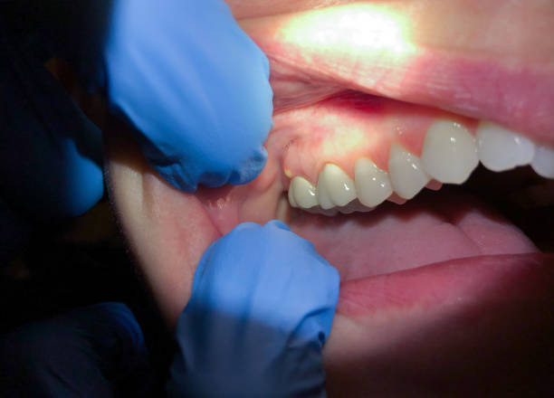 Best Lost Filling or Crown Replacement in Waynesville, MO